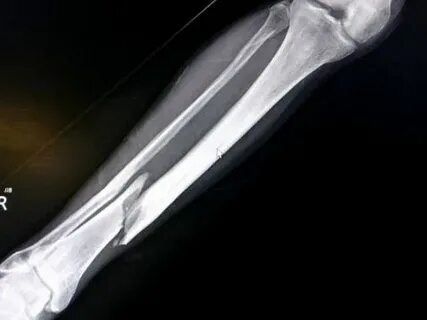Врачи Ясногорска закрыли больничный пациентке, не обнаружив у неё перелома ноги